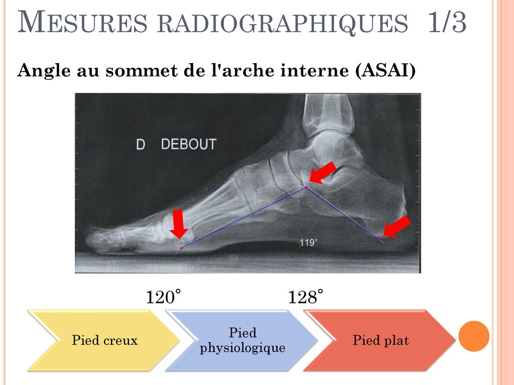 ETUDE DE L INFLUENCE DE L ORIENTATION DE L ARRI RE PIED SUR LA